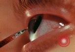 Image of eye surgery United States USA, 1945, second 53 stock footage video 65675077560