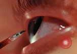 Image of eye surgery United States USA, 1945, second 54 stock footage video 65675077560