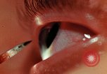 Image of eye surgery United States USA, 1945, second 55 stock footage video 65675077560