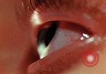Image of eye surgery United States USA, 1945, second 56 stock footage video 65675077560