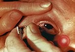 Image of eye surgery United States USA, 1945, second 61 stock footage video 65675077560