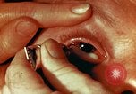 Image of eye surgery United States USA, 1945, second 62 stock footage video 65675077560