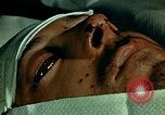 Image of ocular enucleation United States USA, 1945, second 3 stock footage video 65675077561