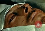 Image of ocular enucleation United States USA, 1945, second 4 stock footage video 65675077561