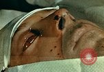 Image of ocular enucleation United States USA, 1945, second 6 stock footage video 65675077561