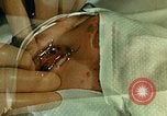 Image of ocular enucleation United States USA, 1945, second 7 stock footage video 65675077561