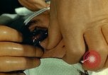 Image of ocular enucleation United States USA, 1945, second 9 stock footage video 65675077561