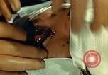 Image of ocular enucleation United States USA, 1945, second 10 stock footage video 65675077561