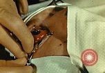 Image of ocular enucleation United States USA, 1945, second 11 stock footage video 65675077561