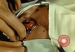 Image of ocular enucleation United States USA, 1945, second 12 stock footage video 65675077561