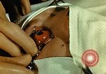 Image of ocular enucleation United States USA, 1945, second 13 stock footage video 65675077561