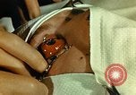 Image of ocular enucleation United States USA, 1945, second 14 stock footage video 65675077561