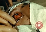 Image of ocular enucleation United States USA, 1945, second 15 stock footage video 65675077561