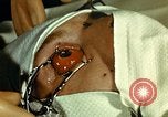 Image of ocular enucleation United States USA, 1945, second 16 stock footage video 65675077561