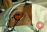 Image of ocular enucleation United States USA, 1945, second 17 stock footage video 65675077561