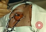 Image of ocular enucleation United States USA, 1945, second 19 stock footage video 65675077561