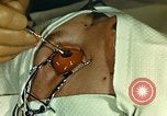Image of ocular enucleation United States USA, 1945, second 20 stock footage video 65675077561