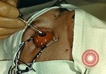 Image of ocular enucleation United States USA, 1945, second 21 stock footage video 65675077561