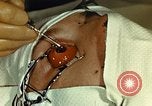 Image of ocular enucleation United States USA, 1945, second 22 stock footage video 65675077561