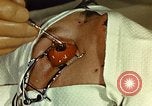 Image of ocular enucleation United States USA, 1945, second 23 stock footage video 65675077561