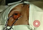 Image of ocular enucleation United States USA, 1945, second 24 stock footage video 65675077561