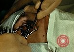 Image of ocular enucleation United States USA, 1945, second 25 stock footage video 65675077561