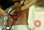 Image of ocular enucleation United States USA, 1945, second 28 stock footage video 65675077561