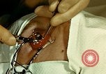 Image of ocular enucleation United States USA, 1945, second 29 stock footage video 65675077561