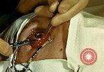 Image of ocular enucleation United States USA, 1945, second 30 stock footage video 65675077561