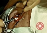 Image of ocular enucleation United States USA, 1945, second 31 stock footage video 65675077561
