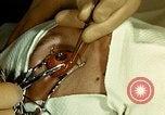 Image of ocular enucleation United States USA, 1945, second 32 stock footage video 65675077561