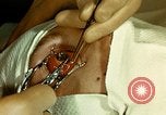 Image of ocular enucleation United States USA, 1945, second 33 stock footage video 65675077561