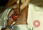 Image of ocular enucleation United States USA, 1945, second 34 stock footage video 65675077561