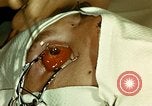 Image of ocular enucleation United States USA, 1945, second 35 stock footage video 65675077561