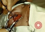 Image of ocular enucleation United States USA, 1945, second 36 stock footage video 65675077561