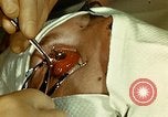Image of ocular enucleation United States USA, 1945, second 37 stock footage video 65675077561