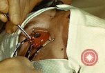 Image of ocular enucleation United States USA, 1945, second 38 stock footage video 65675077561