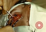 Image of ocular enucleation United States USA, 1945, second 39 stock footage video 65675077561