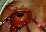 Image of ocular enucleation United States USA, 1945, second 40 stock footage video 65675077561