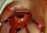 Image of ocular enucleation United States USA, 1945, second 41 stock footage video 65675077561