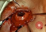 Image of ocular enucleation United States USA, 1945, second 42 stock footage video 65675077561