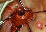 Image of ocular enucleation United States USA, 1945, second 43 stock footage video 65675077561