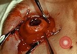 Image of ocular enucleation United States USA, 1945, second 44 stock footage video 65675077561