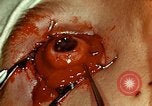Image of ocular enucleation United States USA, 1945, second 45 stock footage video 65675077561