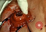 Image of ocular enucleation United States USA, 1945, second 46 stock footage video 65675077561