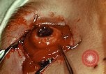 Image of ocular enucleation United States USA, 1945, second 47 stock footage video 65675077561