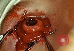 Image of ocular enucleation United States USA, 1945, second 48 stock footage video 65675077561