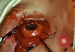 Image of ocular enucleation United States USA, 1945, second 49 stock footage video 65675077561