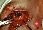 Image of ocular enucleation United States USA, 1945, second 50 stock footage video 65675077561