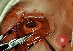 Image of ocular enucleation United States USA, 1945, second 51 stock footage video 65675077561